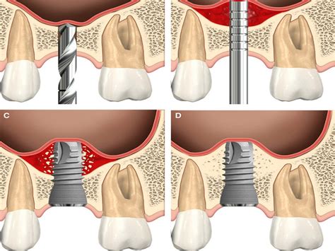  Tricalcium Phosphate:  Revolutionizing Bone Regeneration and Dental Implants!